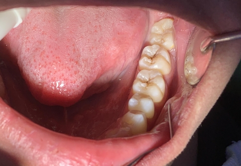 Hàn răng sâu là gì? Khi nào nên hàn răng